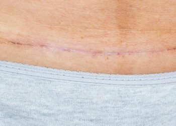 Eignet sich Cannabis zur Narbenrückbildung?