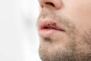 Каннабис и герпес: потенциал каннабиноидов в борьбе с вирусом