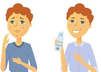 CBD gegen Akne – wie es wirkt und was es kann
