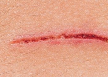 Cannabis und Wundheilung