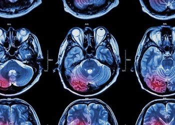 CBD zur Behandlung von Hirntumoren