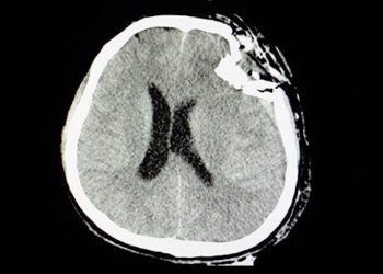 Schädel-Hirn-Trauma und die Einsatzmöglichkeiten von Cannabinoiden
