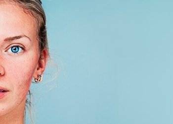 Können Cannabinoide bei der Behandlung von Rosazea helfen?