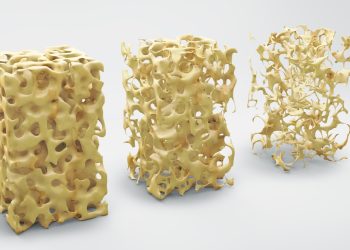 Das Endocannabinoidsystem und Osteoporose