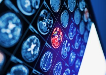 Cannabis zur Rehabilitation nach einem Schlaganfall